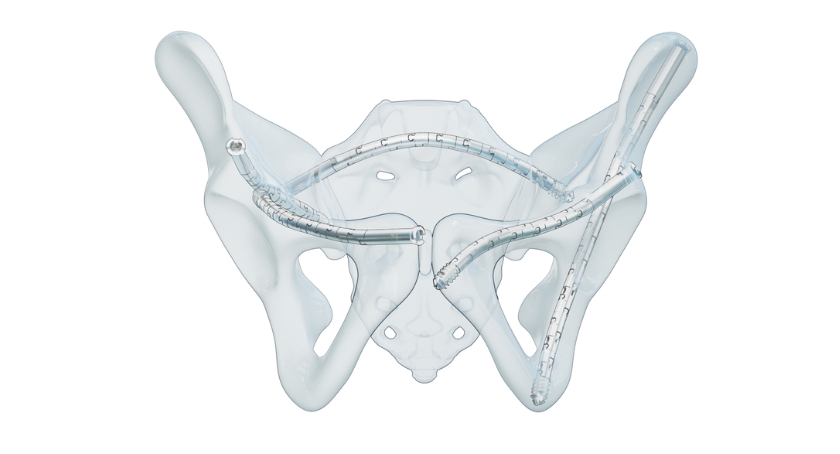CurvaFix Wins FDA Nod for Low-Profile Pelvic Fracture System